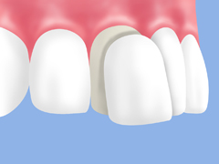 お手軽に前歯を白く～ラミネートベニア～