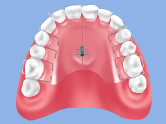 抜歯を回避するための床矯正（顎の骨を広げる床矯正）