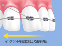 インプラント矯正