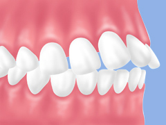 上顎前突（じょうがくぜんとつ）