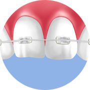 治療効果が高く、目立たない「クリアブラケット矯正」