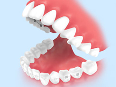 リンガル矯正（上下）よりも手軽で快適、患者様満足度も高い「ハーフリンガル矯正」