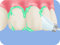 歯のクリーニング