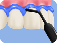 歯ぐきに保護ジェルを塗布